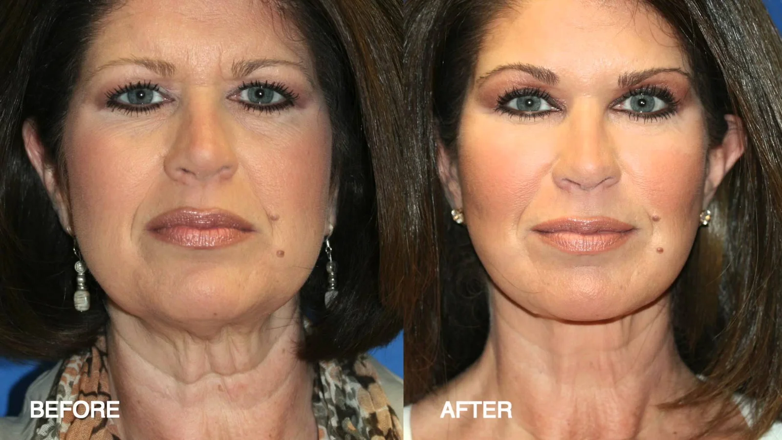 Fat Grafting & Autologous Fat Transfer